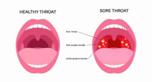 How Strep Throat Symptoms in Adults Differ From a Regular Cold