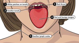 What Strep Throat Symptoms in Adults Look and Feel Like in Detail