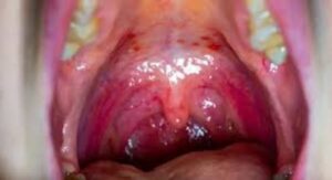 Can Infants Get Strep Throat The Honest Layered Answer First: