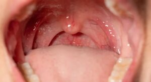 How Long Is Strep Throat Contagious — The Two Timelines You Need to Know
