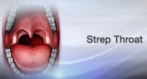 How Long Is Strep Throat Contagious Before You Even Feel Sick