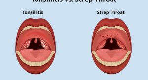 How Long Is Strep Throat Contagious in Specific Situations