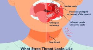 Contagious Strep Throat How Long Peak Window: