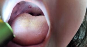 Symptoms Strep Throat Kids Across Age Groups: