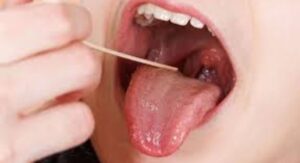 Strep Throat Signs And Symptoms: