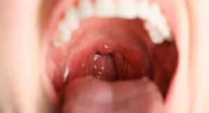 Strep Throat Versus Cold Symptoms: