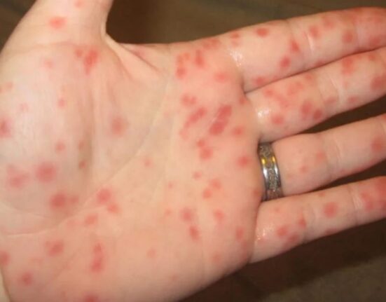 Can Strep Throat Cause Skin Rash - 7 Shocking Facts Nobody Tells You!