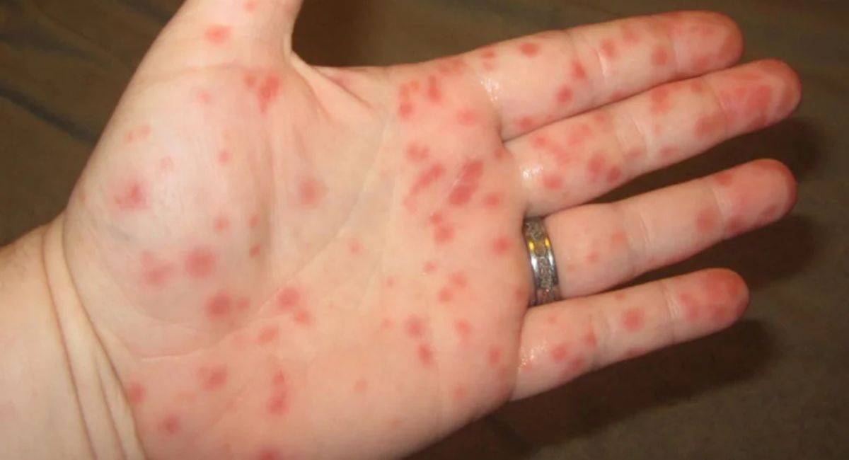 Can Strep Throat Cause Skin Rash - 7 Shocking Facts Nobody Tells You!