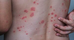 Can Strep Throat Cause Skin Rash — The Short Answer
