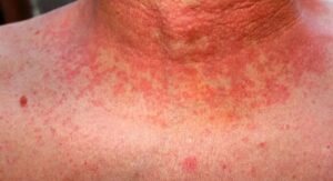 Can Strep Throat Cause Skin Rash Before the Throat Even Hurts