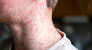Can Strep Throat Cause Skin Rash in Adults — Is It Different