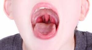 Is Strep Throat Contagious Symptoms During Active Infection