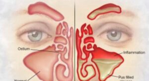 Is a Sinus Infection Viral or Bacterial: Treating Each Type Right: