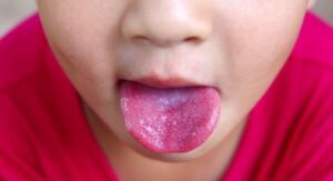 ICD 10 for Strep Throat: When J02.0 Applies and When It Doesn't?