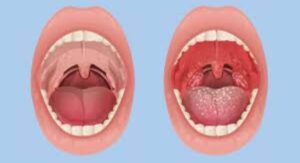 Normal Throat vs Strep Throat: The Speed of Arrival Tells You Something