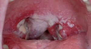 Normal Throat vs Strep Throat: What You See When You Actually Look