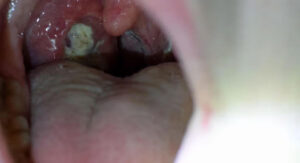 Normal Throat vs Strep Throat: How the Timeline Differs Day by Day