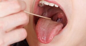 Why Do I Keep Getting Strep Throat The Tonsil Problem?