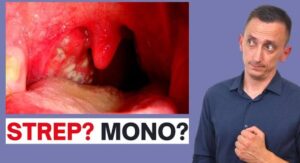 Mono Throat vs Strep Throat How Each One Actually Begins?