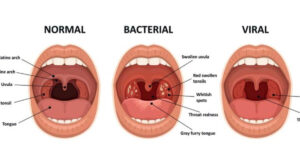 Mono Throat vs Strep Throat How the Timeline Unfolds Differently: